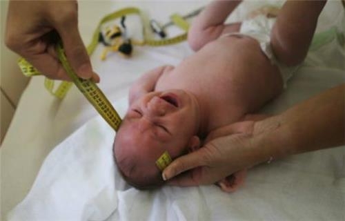 브라질 소두증 확산세 다소 진정…지카 연관성 확인 233명 - 2