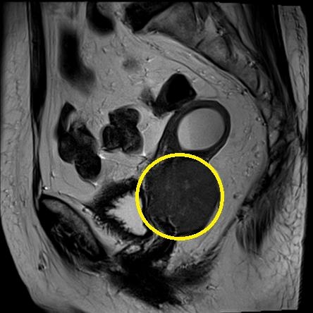 자궁경부암 환자의 MRI 이미지.