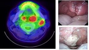 편도암의 PET-CT 영상(왼쪽)과 내시경 사진(오른쪽) (서울성모병원 제공=연합뉴스)