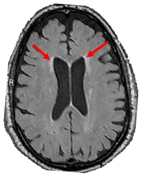 뇌 백질의 병변 부분(화살표)