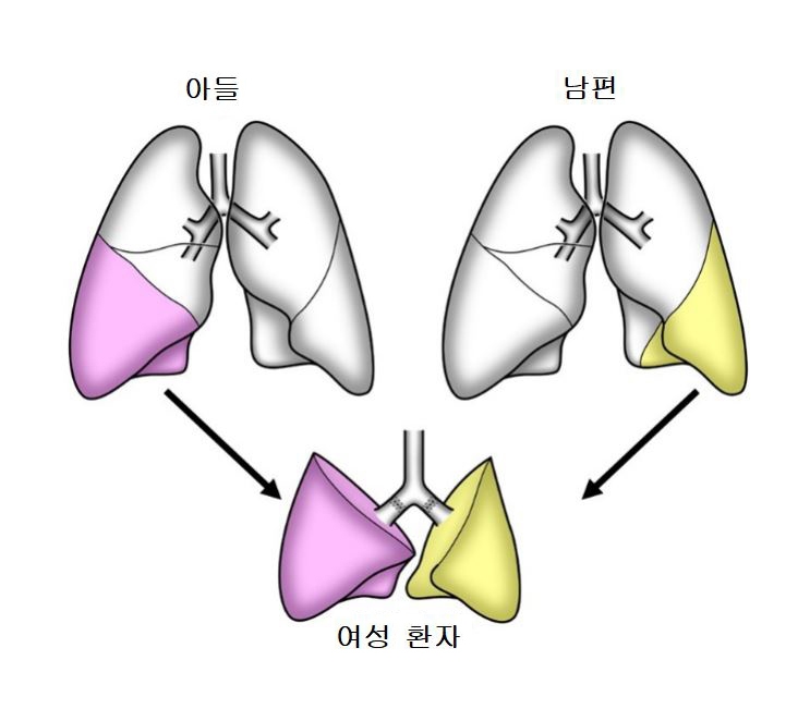 코로나19로 폐 기능 상실한 환자에게 생체 폐 이식