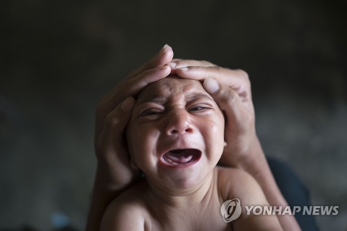 뇌가 정상적으로 자라지 못하는 소두증(microcephaly·小頭症) 환자
<< AP=연합뉴스 >>