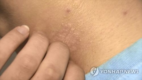 건선