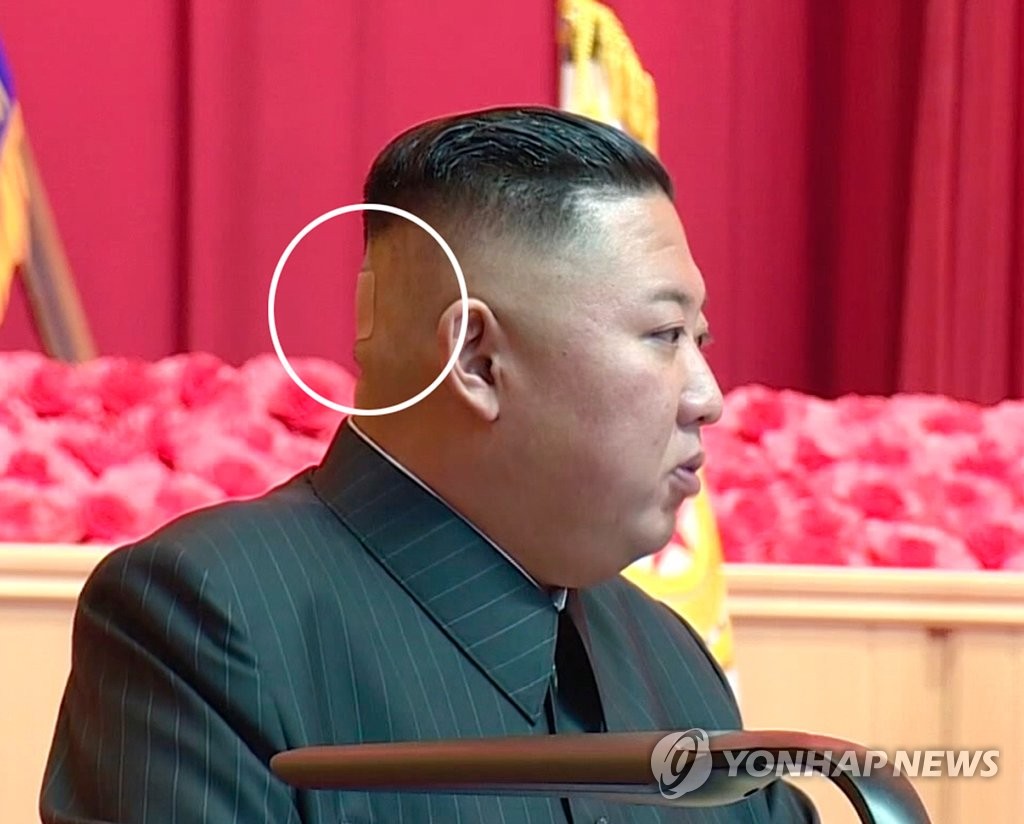 북한 김정은, 뒤통수에 붙인 파스 눈길