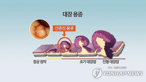 "대장암 성장 촉진하는 대사물질 찾아냈다"