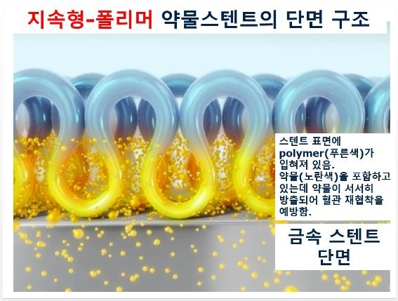 지속형-폴리머 약물 스텐트 단면 구조