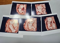 다섯쌍둥이 출산 부부, 1억 7천만원 넘게 지원받는다
