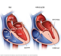 "심장 두꺼워지면 치매 위험↑"