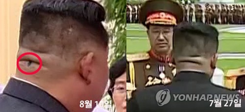 북한 김정은, 뒤통수에 정체불명 검은 자국